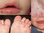 Salud Atacama alerta por casos de boca, mano, pie en menores